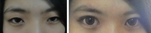 图解3种不同的双眼皮手术方式