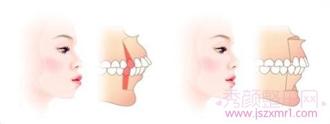 详细介绍突（凸）嘴手术以及突嘴矫正三种方式