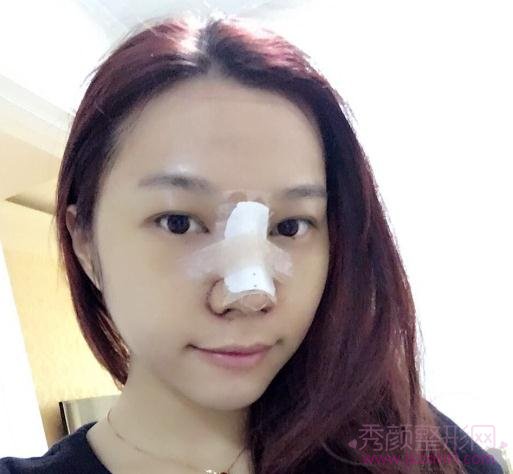 广州鼻部手术隆鼻，两个月恢复分享