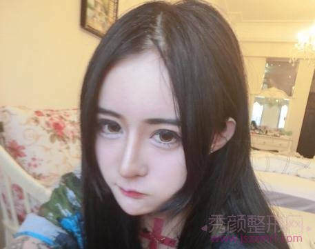上海鲁南门诊双眼皮+眼睑下至+脂肪填充+鼻部手术