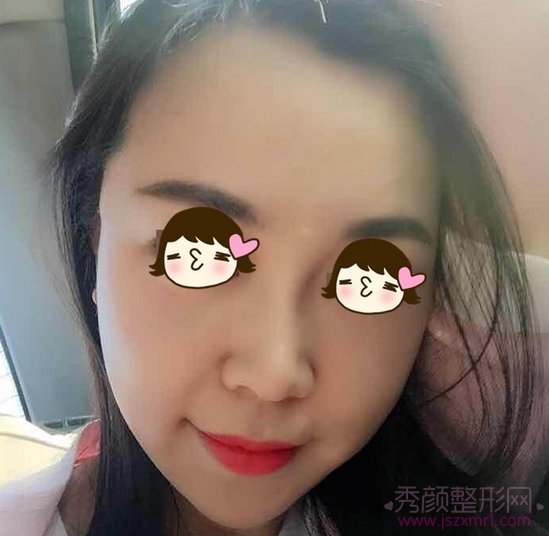 北京做的面部埋线提升术，真的年轻了吗?