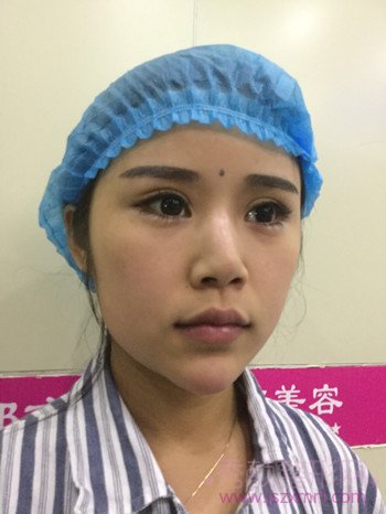 在郑州都市风韵做的鼻部手术已经72天了