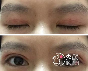 【案例分享】上海九院全切双眼皮恢复记录