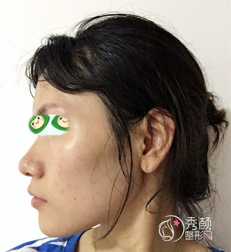 上海华山医院穆雄铮下颌角整形案例。