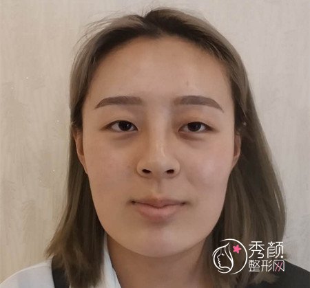 杭州时光下颌角磨骨+隆鼻+割双眼皮案例一枚。