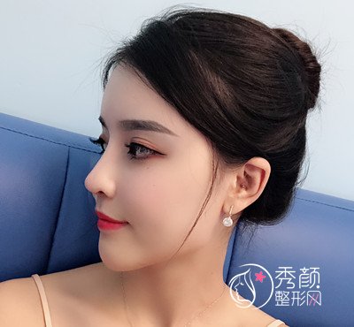 上海华美李健自体脂肪填充+隆鼻案例。