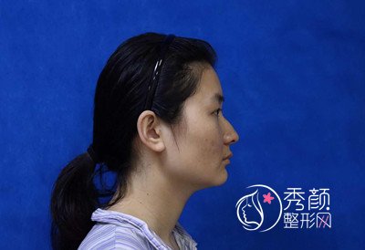上海九院徐梁磨颧骨和下颌角整形案例。
