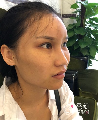 上海华美李志海颧骨内推和削下颌角案例
