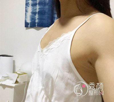 上海华美谢卫国假体隆胸（270cc麦格水滴型）案例