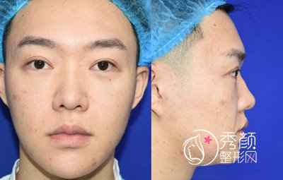 上海男士肋软骨隆鼻案例，恢复好了也是大帅哥一枚！