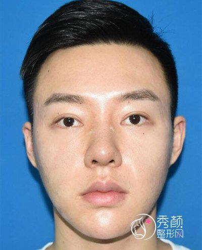 上海男士肋软骨隆鼻案例，恢复好了也是大帅哥一枚！