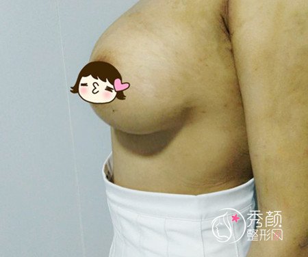 【巨乳缩小】缩胸手术案例分享。