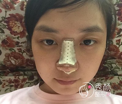 北京整形医生曾高隆鼻怎么样,真实案例分享。