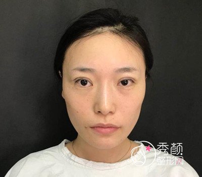 北京韩新鸣割双眼皮怎么样,案例图分享。