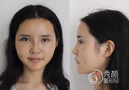 长沙华韩华美割双眼皮+全脸脂肪填充案例分享。