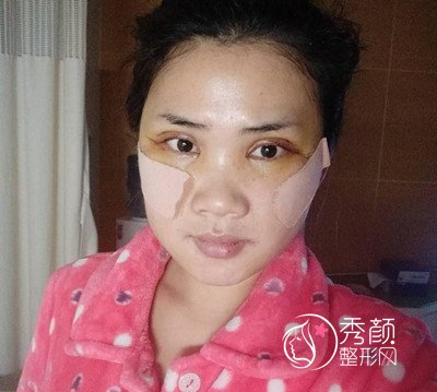 上海华美杨亚益双眼皮修复案例。