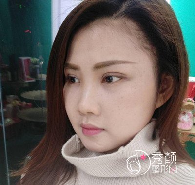上海华美杨亚益双眼皮修复案例。