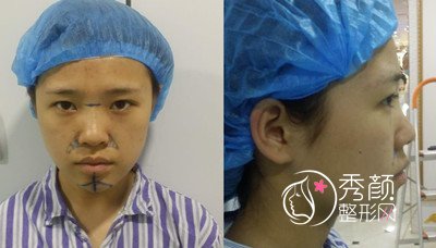 北京隆鼻哪个医生好,彤美桂行军鼻部手术案例。