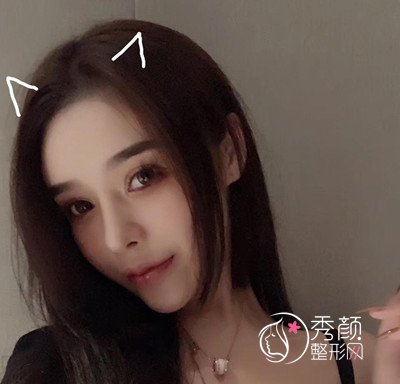 北京隆鼻哪个医生好,彤美桂行军鼻部手术案例。