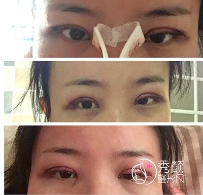 四川省人民医院游晓波割双眼皮案例。