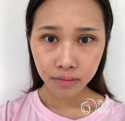 上海容妍国际李昕肋软骨鼻部手术案例。