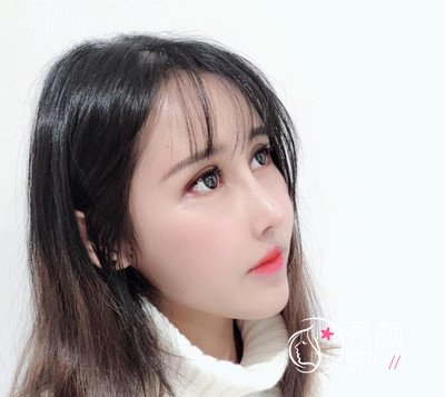 上海容妍国际李昕肋软骨鼻部手术案例。