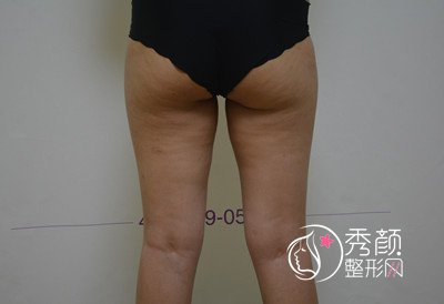 北京禾美嘉全身吸脂+脂肪填充面部案例。