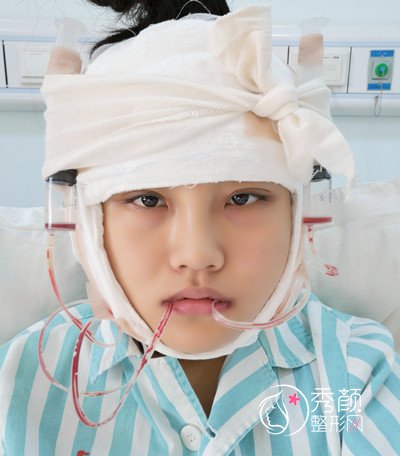 天津美莱罗金超磨骨（VLine瓜子脸）手术案例。
