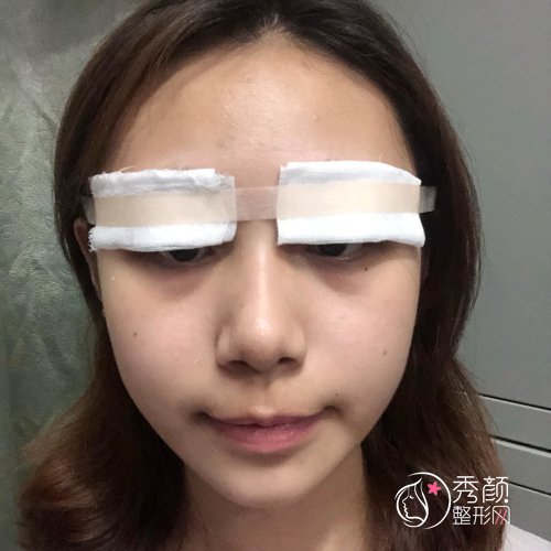 上海盈美杨璐做双眼皮怎么样|附割双眼皮案例