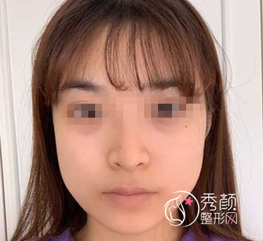 飞到了北京做的下颌角手术，现在的小v脸让我觉得一切真的都很值得！