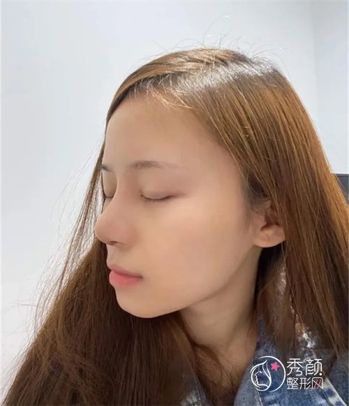 上海做的隆鼻手术，面中凹陷问题终于解决了！