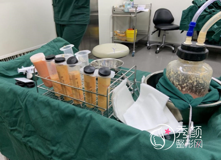上海第九人民医院2023全新抽脂价格表一览|附吸脂医生介绍