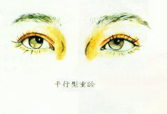 四种双眼皮类型（图解）