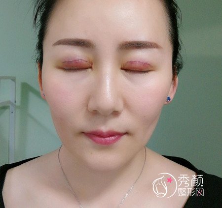 上海九院刘菲双眼皮修复案例分享。