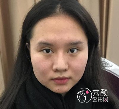 北京禾美嘉任学会自体脂肪面部填充案例过程分享。