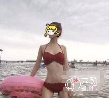 上海美莱袁玉坤吸脂怎么样|附腰腹吸脂案例