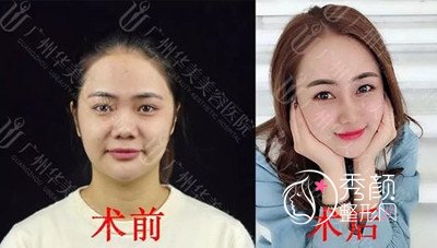 广州哪个医生做鼻子比较厉害罗延平张明兴哪个好