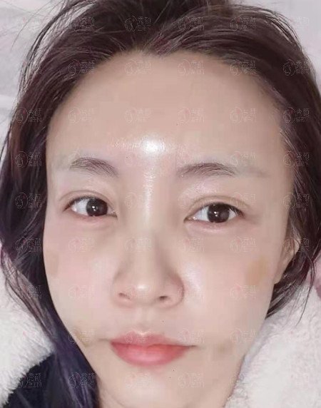 武汉大学人民医院赵月强自体脂肪填充+双眼皮案例。