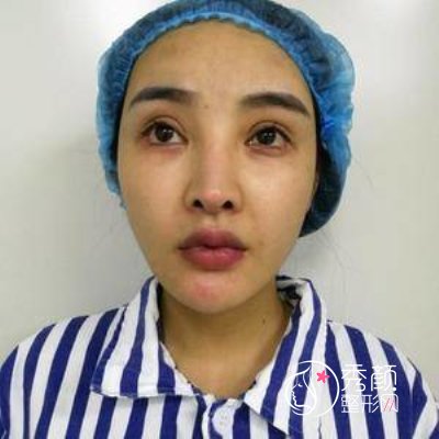 北京八大处杨明勇双眼皮修复案例