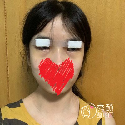 南京黄金龙双眼皮修复技术怎么样,大概需要多少钱?
