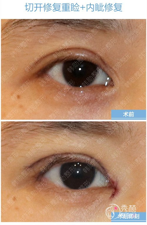 北京韩勋双眼皮修复和眼角修复案例