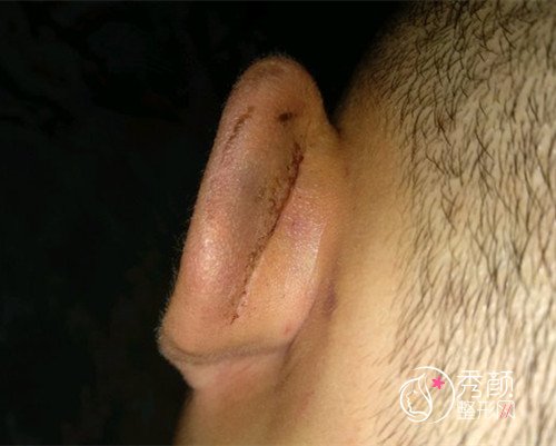【招风耳矫正案例】终于做了左侧招风耳矫正手术。