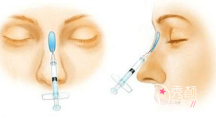 玻尿酸隆鼻跟手术隆鼻区别