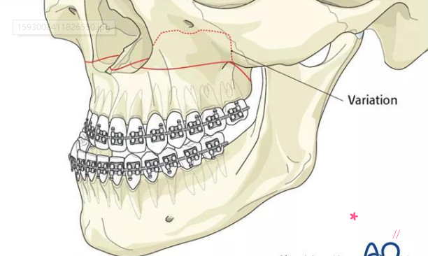 正颌手术果怎么样，正颌手术有什么风险和并发症？