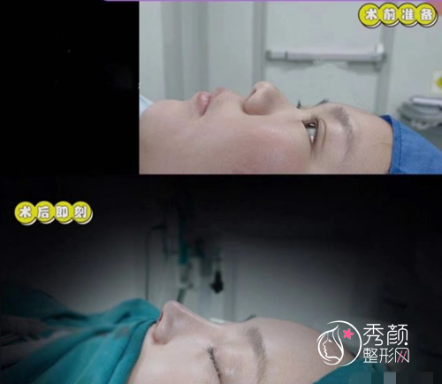 北京八大处隆鼻哪个医生好，八大处隆鼻医生案例技术特点对比。