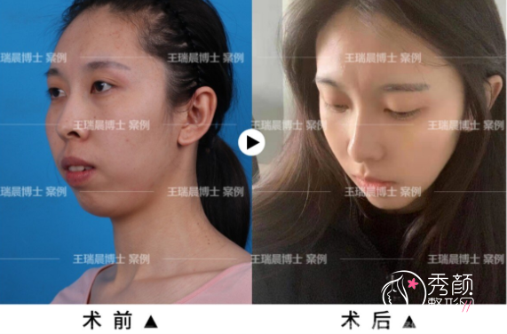 北京联合丽格王瑞晨正颌手术怎么样？附王瑞晨双颌前突矫正+下颏成形术案例