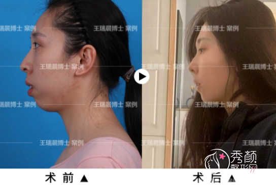 北京联合丽格王瑞晨正颌手术怎么样？附王瑞晨双颌前突矫正+下颏成形术案例