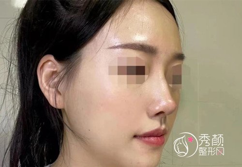 浙江省人民医院整形科晋培红做鼻子怎么样,有没有失败案例？