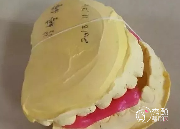 严重的反颌，武汉吴中兴做了正颌手术+切下颌角，现在也是个美人胚子了