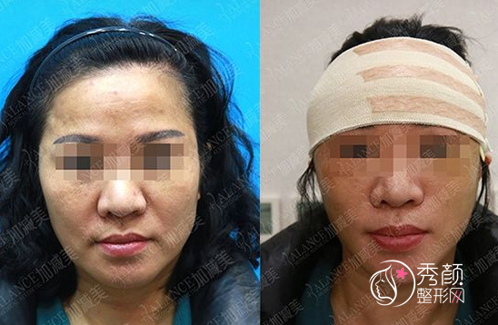 北京加减美穆宝安面部拉皮手术案例